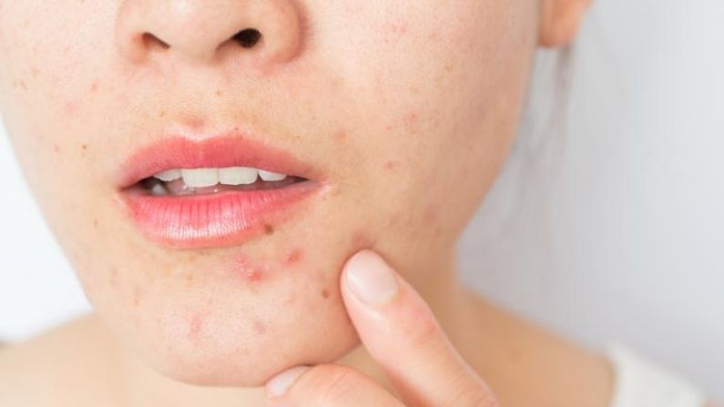 Acne Myths