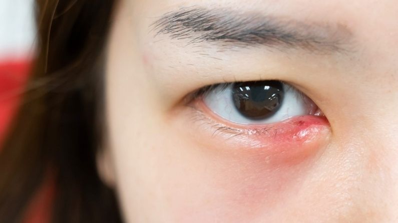 Stye Cure Home Remedies